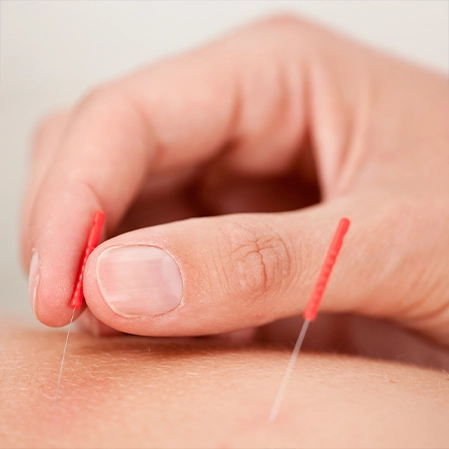 Hand Placing An Acupuncture Needle Into Someone's Skin